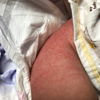 为什么宝宝的大腿上会起红疹呢？是什么引起的