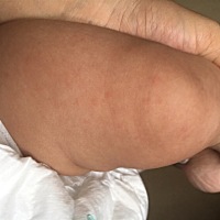 宝妈们，3个月多出湿疹怎么办，用什么好啊，看医生也不好😔😔😔