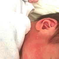 有没有宝妈遇到这种情况的？是什么原因？红色斑斑，医生说胎毒，会消的，可是好担心。