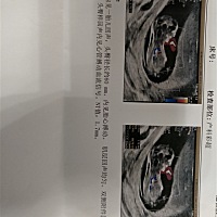 今天做了NT，医生说宝宝很好动，具说NT看男女最准，姐妹们帮我看看吧！很好奇！