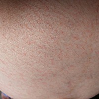 有没有宝妈肚子上长这个的，今天突然肚子上一片都是这个，对宝宝有影响吗？