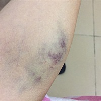 26号晚上抽的血，一个星期了就像被人打的一样，这护士都不知道怎么抽血的！