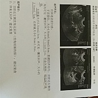 七月三十一号因为阴道褐色分泌物两天 请假去医院检查  抽血化验一切正常  但就是B超显示宫角妊娠待除外 ...