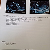 今天去做了NT检查，医生说宝宝头勾着呢，正常吗？有会看男女的吗？