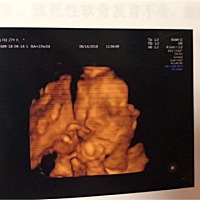 一胎剖，二胎也要剖吗？