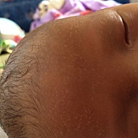 宝宝额头长了好多白痱子 怎么处理好呢？