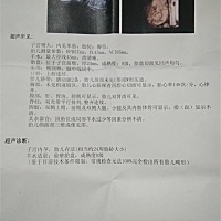 今天刚照的结果，三维超声诊断报告单，请问一下各位亲们，有没有问题？谢谢了！