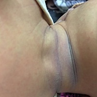 宝宝脖子褶皱的地方突然有点青紫，谁遇到过这样的现象么？