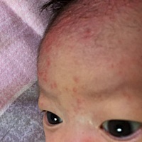 最近几天宝宝额头起了好多红点点，不知道是痱子还是湿疹，有没有一样经历的宝妈，求助，怎么才能消下去呢？