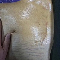 把肚子上的纹 全部全部去掉