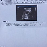 哪位帮我看下这里面数据哪个是孕囊大小啊，还有那两个黑黑的是眼睛吗