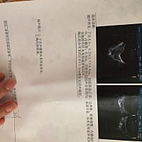 我想问下大家我这个陶氏积液严不严重