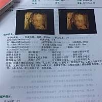 今天做的二宝四维，娱乐娱乐，帮我看看男女😄图二是大宝贝的四维图，2岁啦，长得像他爸，希望这个宝贝...