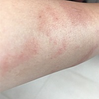 孕妈们你们怀孕有出现过这样的情况吗？手臂上 肚子上面有一些这样的红块，非常痒，又不能挠，不能使用什...