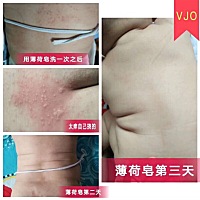 夏天这么热，宝宝身上会不会有一些湿疹、痱子呢？还在用药膏吗