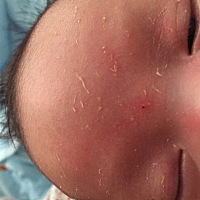 为啥宝宝脱皮那么严重 今天十六天了