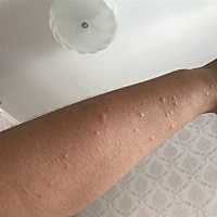 刚怀孕一个多月，身上出疹，特别痒，谁出过？救命啊