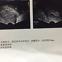 各位jms可以帮忙看看彩超吗？下面这个图没有优势卵泡吗