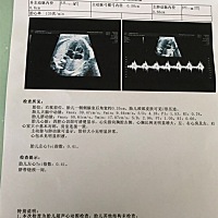 这咋还绕颈了？还好医生说没事！看胎心能不能看出来男孩女孩？