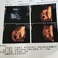 12周加5天做的检查，能看出男孩女孩了吗，哈哈