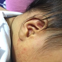 24天的宝宝，脸上起了好多这种痘痘。是什么情况？哪位妈妈知道的，麻烦指教。