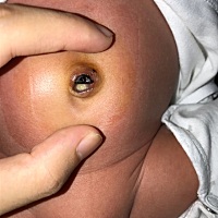 有没有和我家宝宝一样的情况  肚脐脱落后有点渗血渗液 今天第17天了肚脐眼是这个样子的 不知道正常不正...