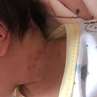 有宝妈知道这是什么吗？拍了图片问医生，医生说没事！不用管它！但看了都心疼丫