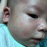 50天宝宝脸上湿疹反反复复怎么办 药膏有激素不敢乱用 宝妈有什么建议呢