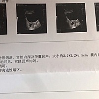 孕50天，接好胎心胎芽