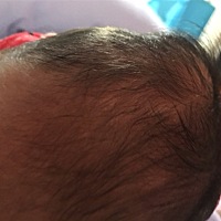 宝宝出生第三天，头顶突然冒出一个包，宝宝不痛，是产后血肿吗？