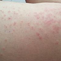 孕晚期有没有长疙瘩的宝妈啊，该怎么治疗啊