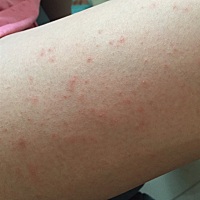 8个月了，腿上和肚子上起了很多，这是啥有知道的么？