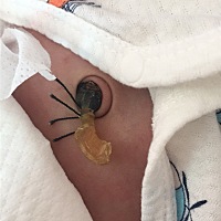 宝宝18天了脐带还没掉今天早上擦出血之前医生说淤血没事这是淤血还是鲜血啊……拜托🙏生过的宝妈给点...