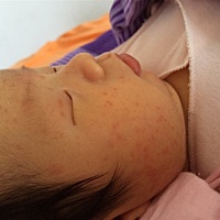 宝宝这几天脸上长出好多红点点。不知道是怎么回事。有知道的吗？