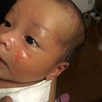 各位宝妈，小孩脸上长了这种湿疹一样的东西，这是前几天拍的 现在脖子上也有了 ，脸上也越来越多。要去...