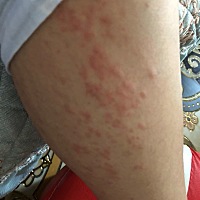 有宝妈产后长了这种疹子的吗？想问下多久能好，我现在大腿上小腿上都有