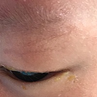 请教有经验的宝妈眼屎的宝宝怎么处理的啊，新生儿20天。