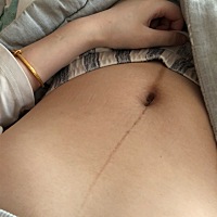 宝妈们生完宝宝肚子上的黑线会消掉吗？要多久？