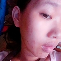 之前还的一个月之前还没有这些痘痘现在差不多快三个月了那痘痘好多