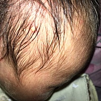 亲们    有谁知道我宝宝头上长的这个脓包是喝奶粉上火的原因吗