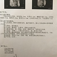 40周羊水少，8.9号晚上破腹产6.2斤男宝。 发下宝宝出生当天的照片，简直和四维一毛一样！ 今天出院啦！
