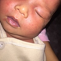 宝宝的脸上是痱子吗？     宝妈们有没有什么好办法。    看着心疼