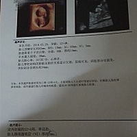 今天去做nt没通过遍厚，哎，心好累，过几天就要去做羊水穿刺了