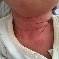 宝宝出生9天、长了这些红点点、是湿疹吗？能用药吗？