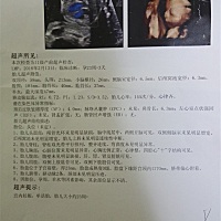 这个四维是不正常的结果吗？潜在染色体异是代表不好吗