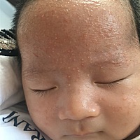 宝宝出生到现在一直长湿疹，两个月了，药膏也擦了，药浴也做了，不见好转，该怎么办啊，