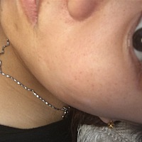 孕妈们有没有怀女孩脸上长斑的30周了