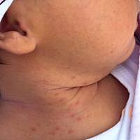 宝宝今天第13天了，今天测了黄疸有16，请问各位宝妈有什么好的办法退黄疸吗？