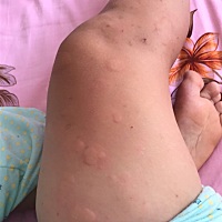 孕晚期就长这个东西 现在生了几天了还是长 大家有什么治疗方法吗