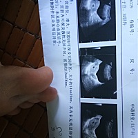 这个是8月20号做的第一次彩超单